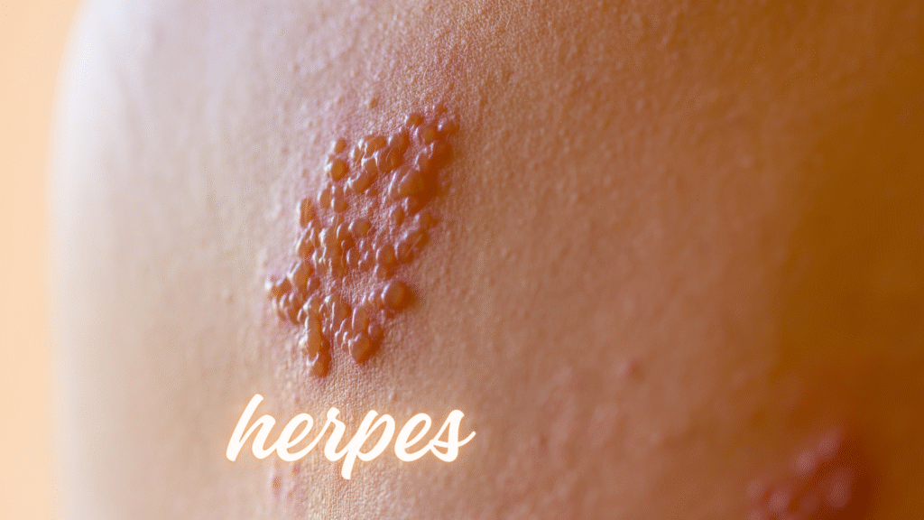 Herpes Genital na Gravidez e a Via de Parto