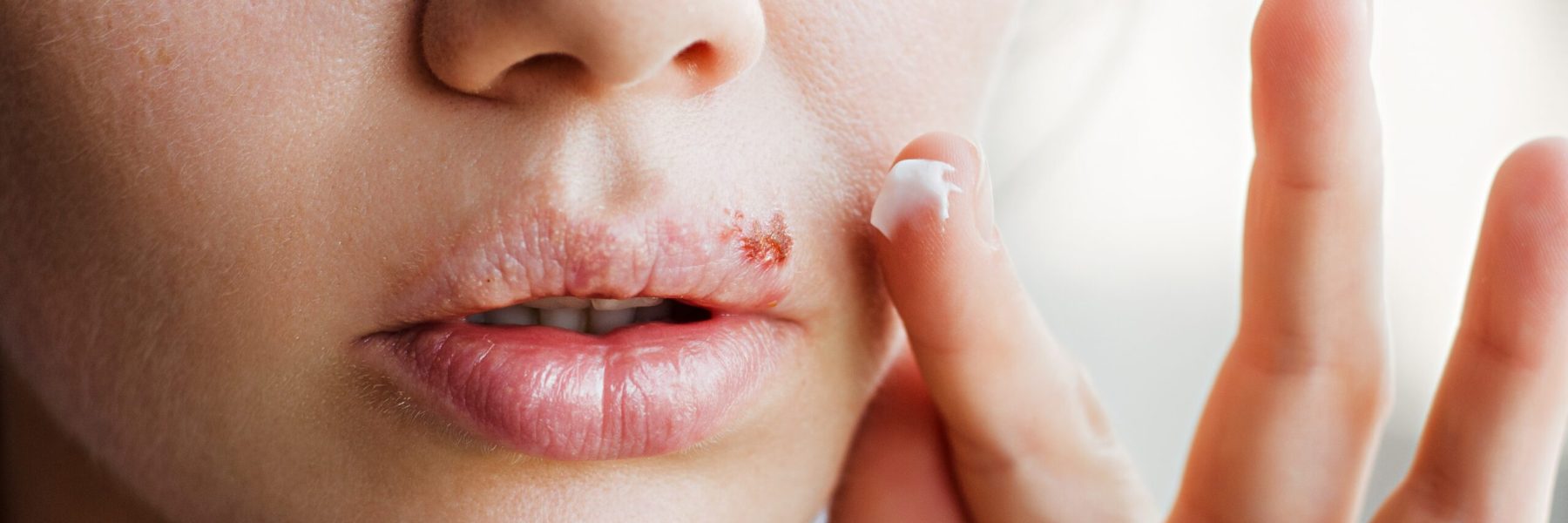 Part of a young woman's face with a virus herpes on lips, treatment with ointment