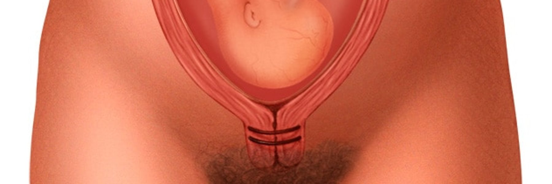 mcdc7_cervical_cerclage-6col